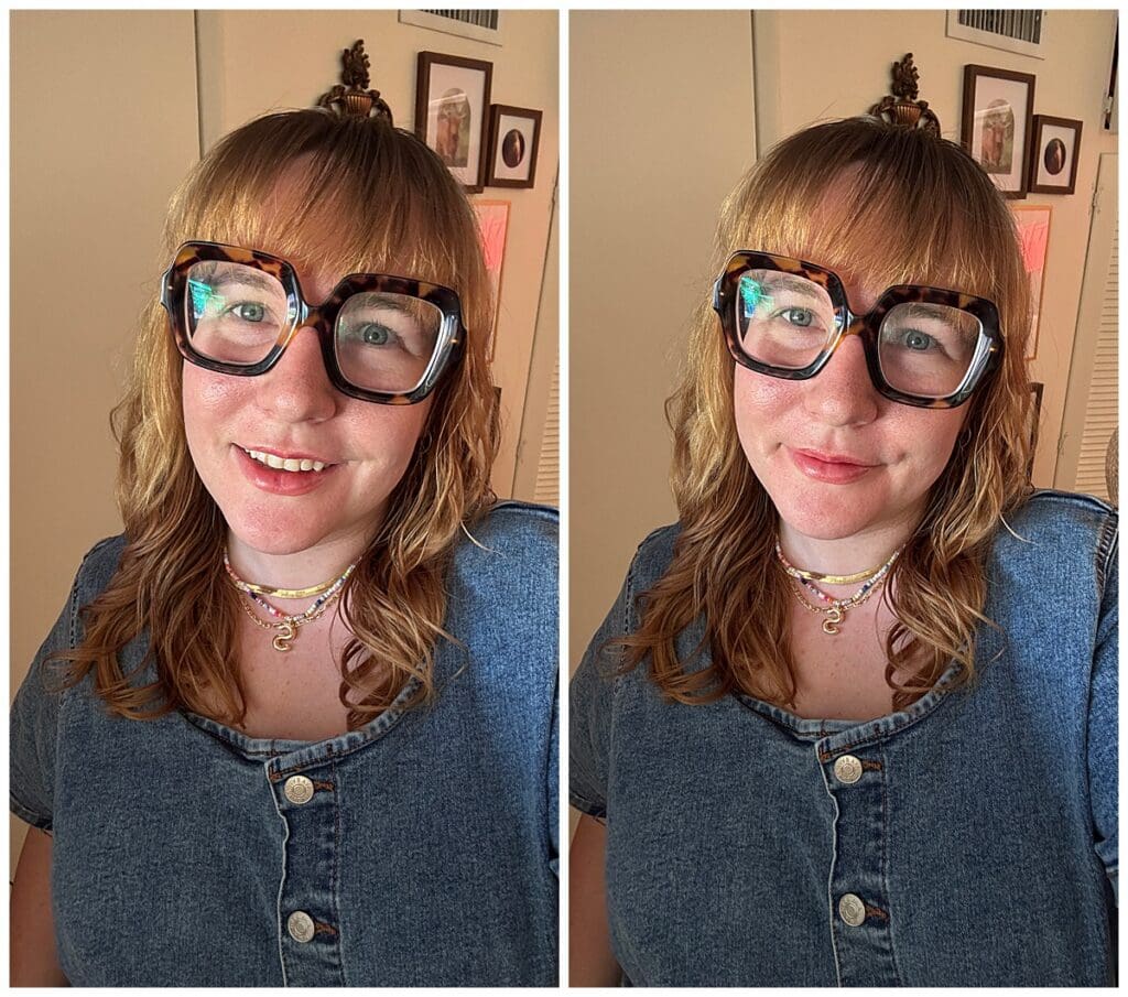 two weeks post botox